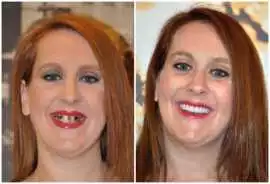 Dental Implants in Delhi - Smiles with Expert Care, Delhi