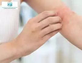 Drug Allergy Rash Treatment – Get Relief , Corona