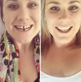 Tooth Gap Treatment in Vasant Kunj – Redefine Your, Delhi