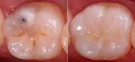 Restore Your Smile with Expert Cavity Filling Care, Delhi