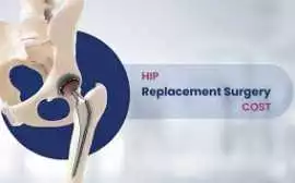 Hip Replacement Surgery Cost in India - By Top Sur, Noida
