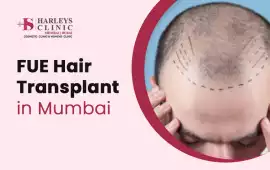 Detailed Benefits of FUE Hair Transplant – Safe &a, Mumbai