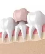 Durable Dental Crowns in San Antonio, TX – Ziva De, San Antonio