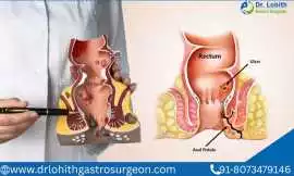 Fistula Treatment in Bangalore by Dr. Lohith U    , Bengaluru