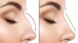 Rhinoplasty in Dubai, Abu Dhabi | Dr. Parag Telang, Dubai