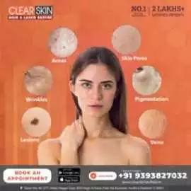 best pulsed dye laser treatment in india, Kurnool