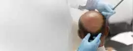 Affordable BIO FUE Hair Transplant in Mumbai for P, Mumbai