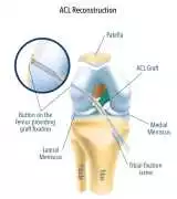 Get Moving Again with ACL Ligament Reconstruction, Sandringham