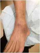 5 Treatment of cartilage repair surgery, Bukit Timah