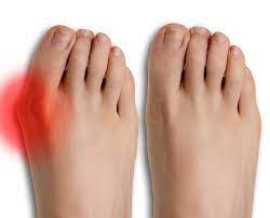 6 bunion treatment ease of pain in Singapore, Novena