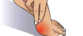 6 Bunion Care Services , Novena