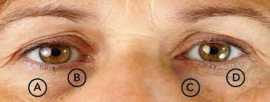 7 Treatments for Dark Eye Circles , Bukit Timah