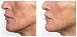 PRX Derm - New Jersey Med Spa, San Francisco