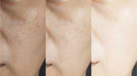 Pores Reduction - New Jersey Med Spa, Iselin