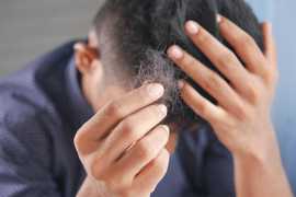 Restore Your Hair with FUE Transplant Surgery!, Richmond