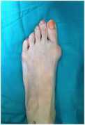 5 Remedies for foot bunion surgery , Novena