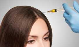 PRP Scalp Injection Treatment in New Jersey, Iselin