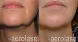 Aerolase laser treatment in New Jersey, Iselin