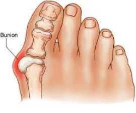 Can valgus hallux be treated without surgery?, Novena