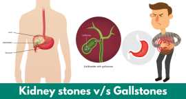 The Role of Food in Managing Gall and Kidney Stone, Spring Hill