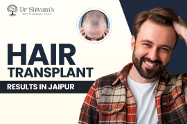 Hair Transplant Results in Jaipur | Dr. Shivam Goy, Jaipur