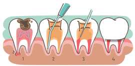 Affordable Root Canal Treatment at Kamal Dental Cl, Delhi