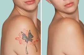 Experience Effective Advanced Laser Tattoo Removal, Orlando