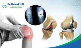 Best Knee Replacement in Sarjapur Road Bangalore, Bengaluru