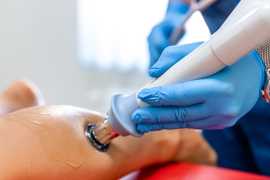 Sclerotherapy Treatment In New Jersey , Jersey City