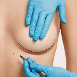 Breast Augmentation Using Fat Transfers, Cos Cob
