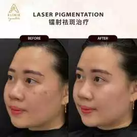Skin Pigmentation Facial Treatment in KL, Petaling Jaya