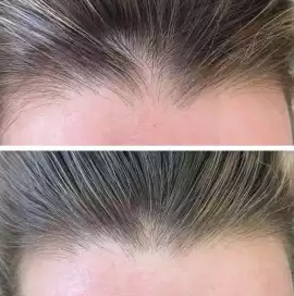 Hairline Tattoo: Restore Confidence, Vancouver