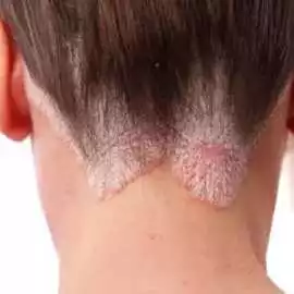 Psoriasis Treatment In Gurgaon - Estique Clinic, Gurgaon