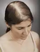 Natural Hair Extensions for Balding – Restore, Chicago