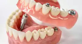 Dental Implants In Siliguri, Siliguri