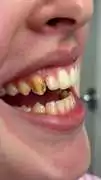 Protect Your Smile from Tooth Decay with Clarity D, 100 Mile House