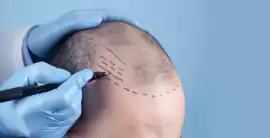 Natural-Looking Hair Transplant in Mumbai, Mumbai