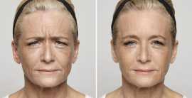 Dysport Treatment in New Jersey, Iselin