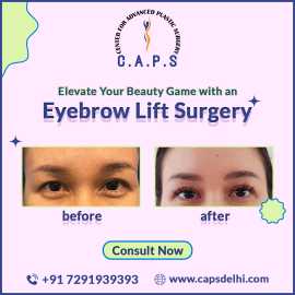 Eyebrow Lift Surgery In Delhi, New Delhi