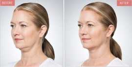 Kybella treatment in New Jersey, Iselin