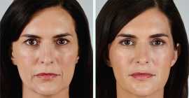 Juvederm Filler Treatment in Edison, Iselin