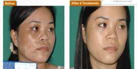 Melasma Treatment in San Francisco, San Francisco