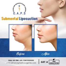 Liposuction Surgery in Delhi, New Delhi