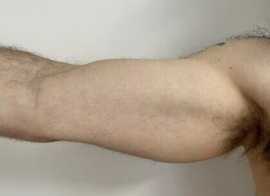 Tricep Implant Surgery San Francisco: Procedure, R, San Francisco