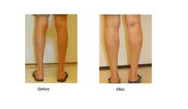 Calf Implant Surgery San Francisco, San Francisco