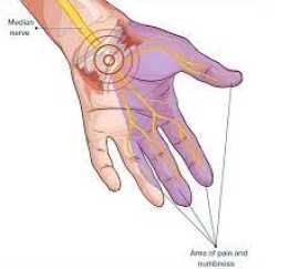 5 Ways to eliminate carpal tunnel symptoms , Novena