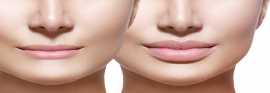 Enhance Your Beauty With Lip Augmentation In Kolka, Kolkata