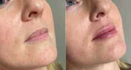 Enhance Your Beauty- The Ultimate Guide To Lip Fil, Kolkata