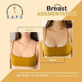 Breast Augmentation in Delhi, New Delhi