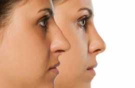 Rhinoplasty San Francisco: Nose Job Procedure, Bef, San Francisco